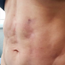 Fibrosis Post-Cirugía fibrosis post cirugía