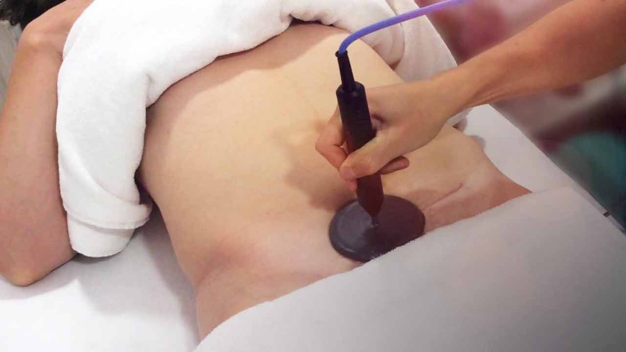 tratamiento para cicatriz de cesárea tratamientos para cicatriz de cesárea