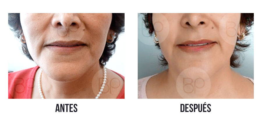 antes y después de lifting sin cirugía