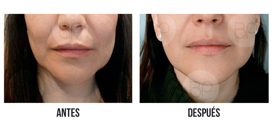 antes y después de lifting sin cirugía