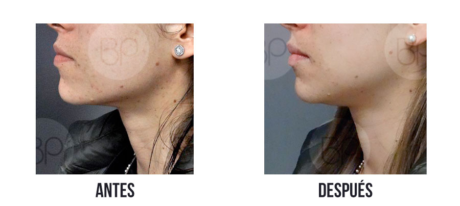 antes y después de tratamiento facial