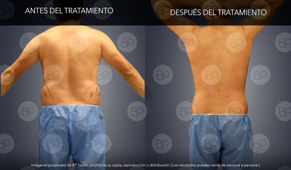 Liposucción Sin Cirugía Hombres | Corporales